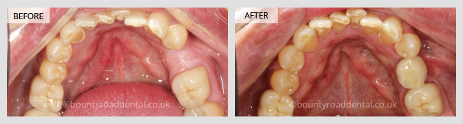 Single Crown Implants