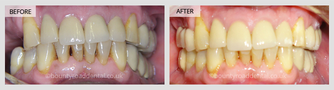 Implant Bridge