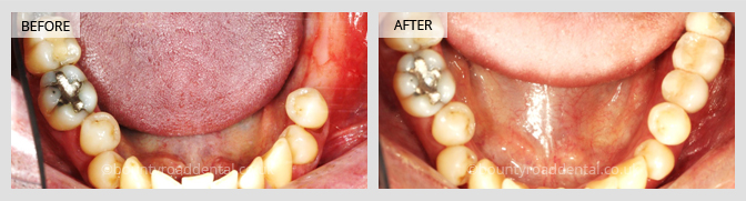 Implant Bridge