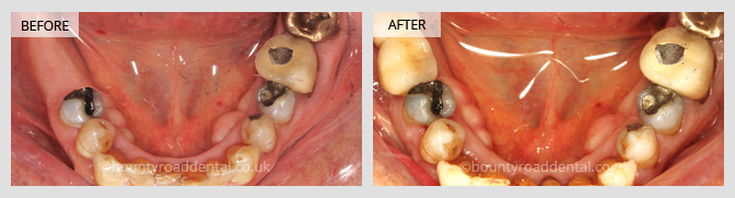 Implant Bridge