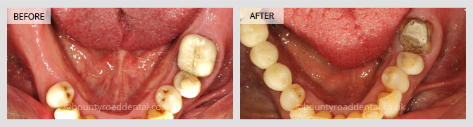 Implant Bridge