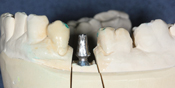 Single Crown Implants