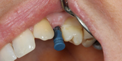 Single Crown Implants