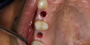 Single Crown Implants