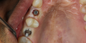 Single Crown Implants