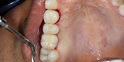 Single Crown Implants