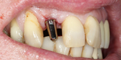 Implant Front Case