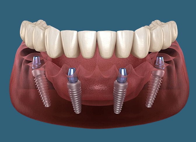 Teeth In A Day